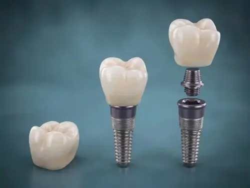Implantes Dentales