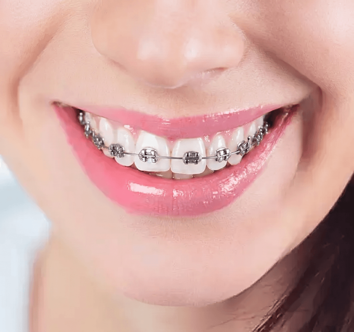 Sistema de Brackets